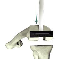 Triathlon Single-Use Instrumentation Instrument Bar > Remove the Femoral Chamfer Resection Guide