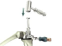 Posterior Referencing Surgical Protocol > Once this is secured, the appropriate size Keel Punch is placed into the Keel Punch Guide. A mallet is used to impact the punch into the tibia.