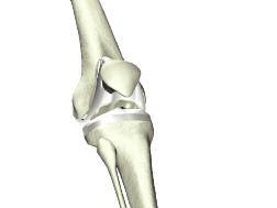 Posterior Referencing Surgical Protocol Symmetric or Asymmetric Patella > Cementless: The peri-apatite coated patellar implant is pressed into the patella using the Patella Clamp.