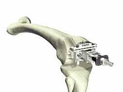 Anterior Referencing Surgical Protocol > The T-Handle Driver is attached to the 5/16 inch IM Rod. The rod is inserted into the anterior referencing femoral alignment assembly.