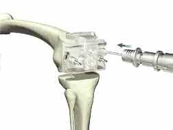 Anterior Referencing Surgical Protocol > Pin assembly onto bone to ensure AP Resection Guide is
