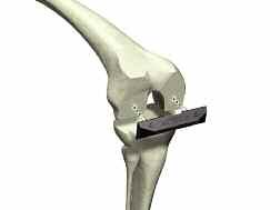 Anterior Referencing Surgical Protocol > Remove the Headless Pins from the guide using the Headless Pin Extractor and remove the guide from the bone.