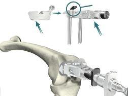 side of the MIS Proximal Rod and slide the fixation arm to the desired location.