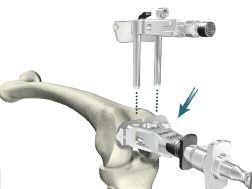 appropriate Left or Right Distal Resection Guide and assemble it onto the MIS Adjustment Block.