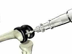 Anterior Referencing Surgical Protocol > Remove the Femoral Impactor/Extractor and Impaction Handle and assess the fit of the PS or CR Femoral Trial.