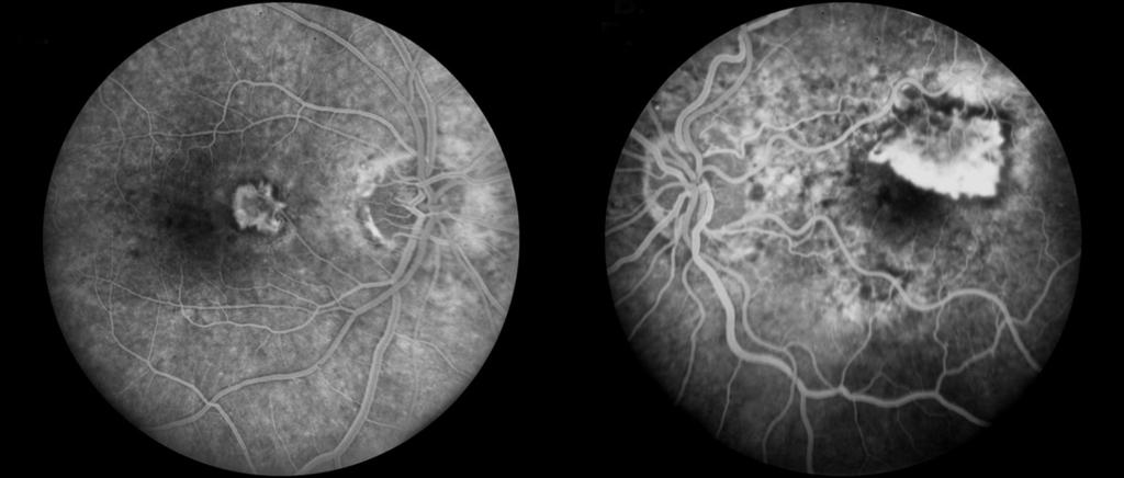Except for a single case report, the studies reported on patients whose neovascularization extended beneath the center of the foveal avascular zone (7).