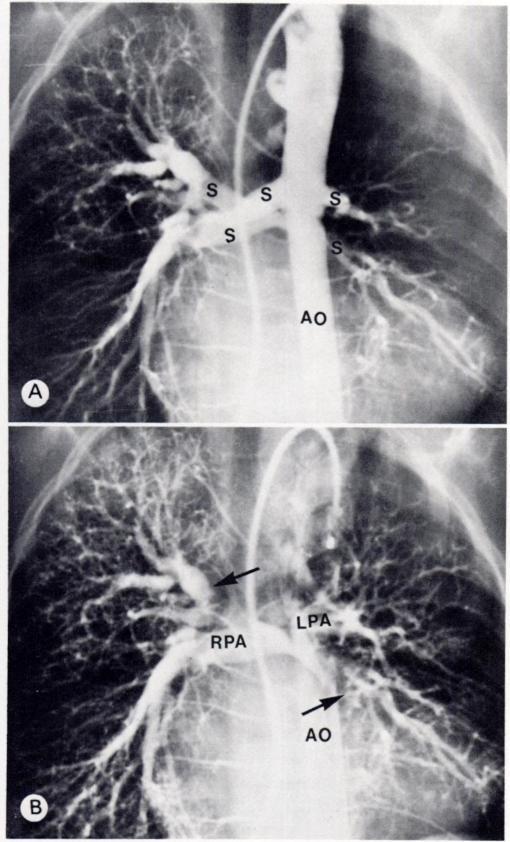 Large vascular shadow is seen in right suprahilar region, indicating presence of abnormal vessel. Right and left pulmonary arteries not identified in B.