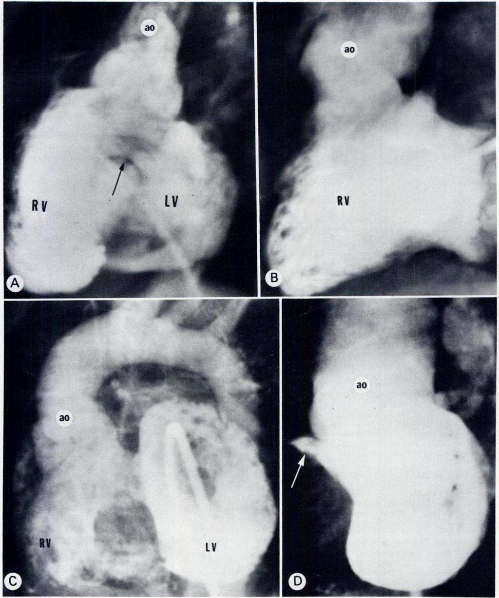 CONGENITAL PULMONARY ATRESIA WITH VENTRICULAR SEPTAL DEFECT 1029 TI. #{149}1 Fig. 1.-Origin of aorta.