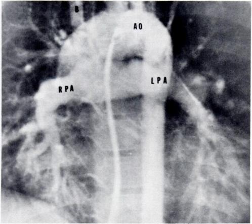 of the 66 patients. Fig. 2.-Aortogram showing pulmonary arterial system in patient with confluent pulmonary arteries and right Blalock-Taussig shunt. Tip of catheter is in aortic arch (AO).