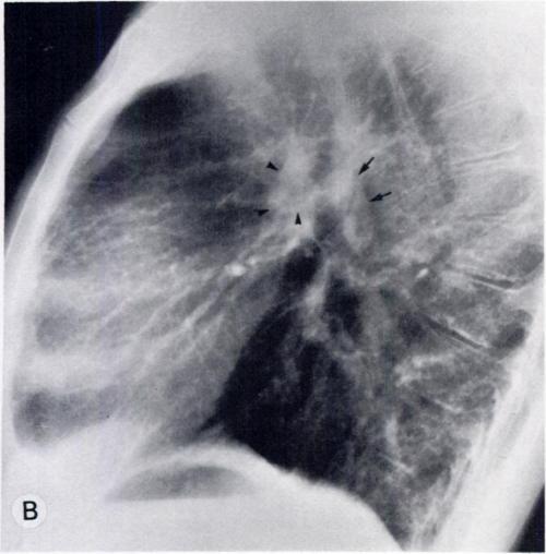 -A, Postenoantenion chest film of patient with confluent pulmonary arteries showing diminished peripheral pulmonary vascularity and large abnormal vascular shadows at left hilum (arrows) and more