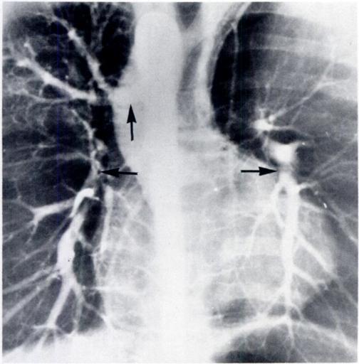 In addition, large bronchial artery supplies right upper lobe (vertical arrow). Vessels outlined by horizontal arrows have angiographic appearance of pulmonary arteries.
