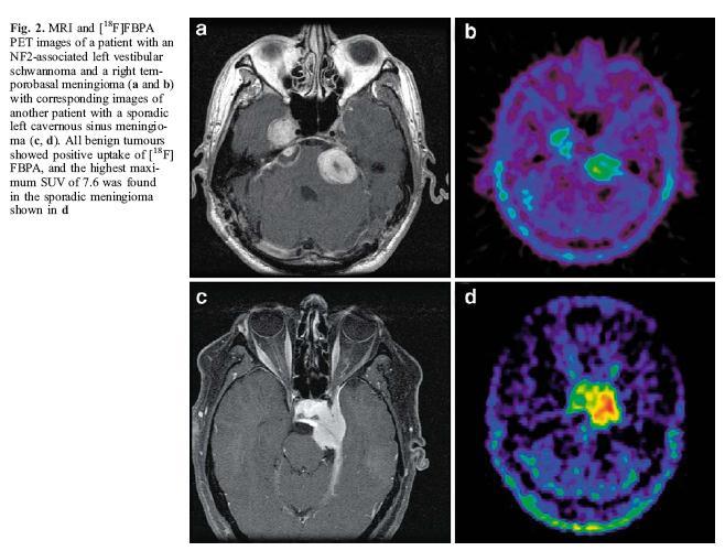 PET models for BNCT and clinical applications Meningiomas and schwannomas might respond to low-dose BNCT with BPA owing to their growth