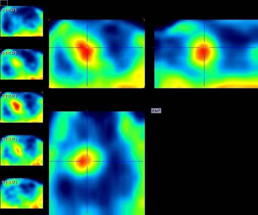 18 F-FET images obtained with small animal PET scanner on the animal model of Glioma