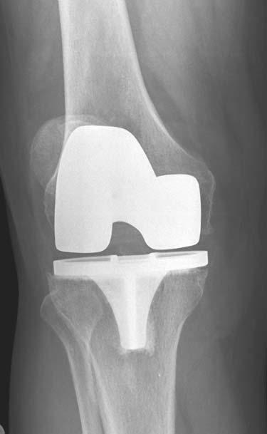While average 3- to 5-year follow-up results from both Engh and Babis suggest that isolated tibial insert exchange is not a viable option for polyethylene wear, with 27%