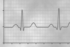 C H A P T E R 1 1 The Normal Electrocardiogram When the cardiac impulse passes through the heart, electrical current also spreads from the heart into the adjacent tissues surrounding the heart.