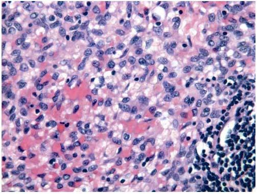 An intra-operative frozen section diagnosis of spindled cell tumor with rich reactive lymphoid infiltrate was rendered.