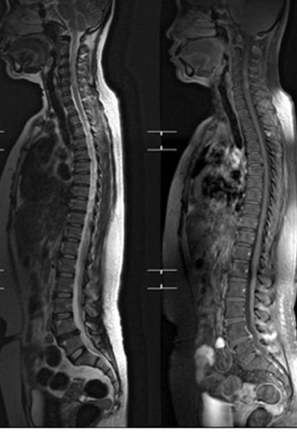 Neuromyelitis Optica (NMO) C D A B Figure 2: A, B: MRI whole spine neutral position: the sagittal T2- weight MR image shows a long segment of hyperintensity at cervical cord at level 2-6 with cord