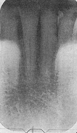The triangular opacity is a normal structure, the coronoid process of the mandible. Left, Radiolucency on root of a tooth. This radiograph shows an example of extemal resorption.