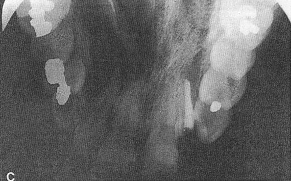 The large radiolucency in the right maxilla illustrates a radicular cyst arising from tooth no. 7.