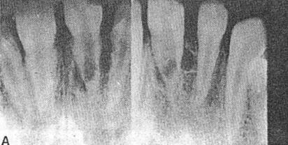 Radiolucency on crown of a tooth. The radiographs illustrate different causes of a radiolucency on the crown of a tooth.