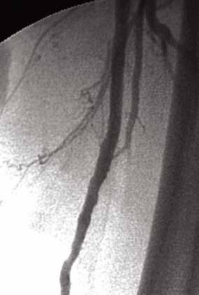 The popliteal artery was normal, and the patient had single-vessel runoff via the anterior tibial artery.