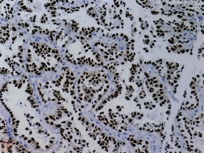 (C) Breast origin lung adenocarcinoma showing strong staining for CK7.