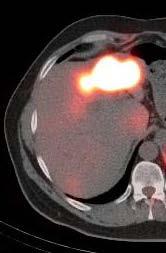 Another case where Bremsstrahlung demonstrated how much tumor was