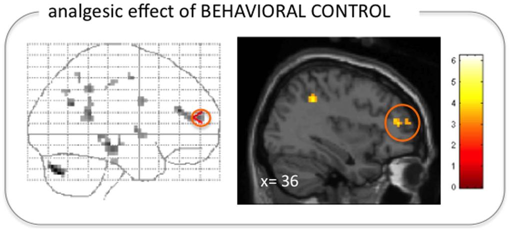 Fig. 3. Right VLPFC correlated with the analgesic effect of the behavioral control modulation.