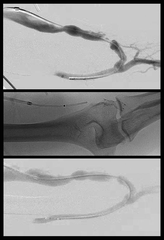 cephalic vein banding site Stabilize collapsing banding site Banding collapse brachial artery Banding of access to 3mm on 11-2-2015, flows from 2400 ml/min to 780