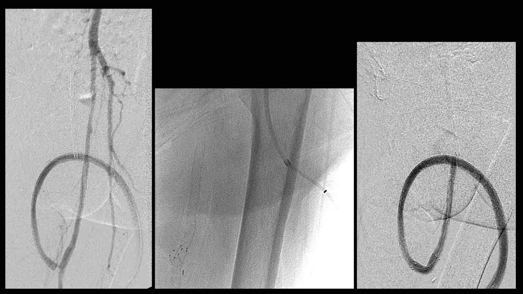 Anastomotic Revision End-to-Side to End-to-End Conversion common femoral artery femoral artery eptfe graft deep