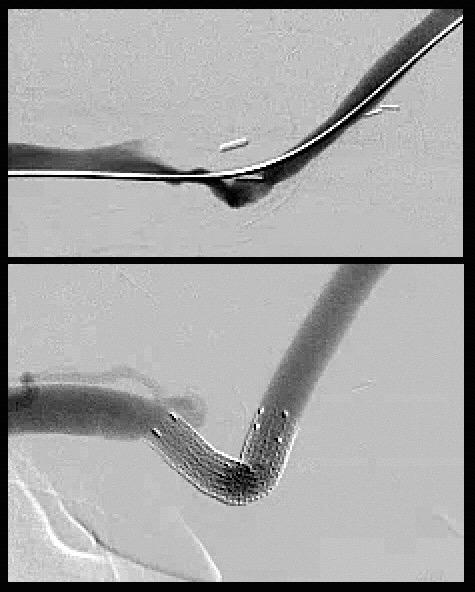 Cephalic Arch and Basilic Swing Point basilic outflow vein angioplasty of basilic swing point