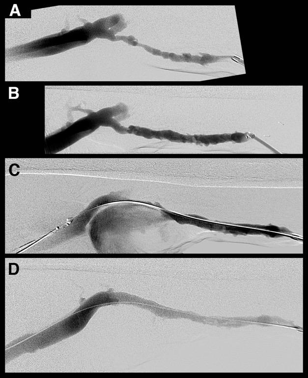 basilic outflow vein swing point Angioplasty Complication A. before angioplasty B.