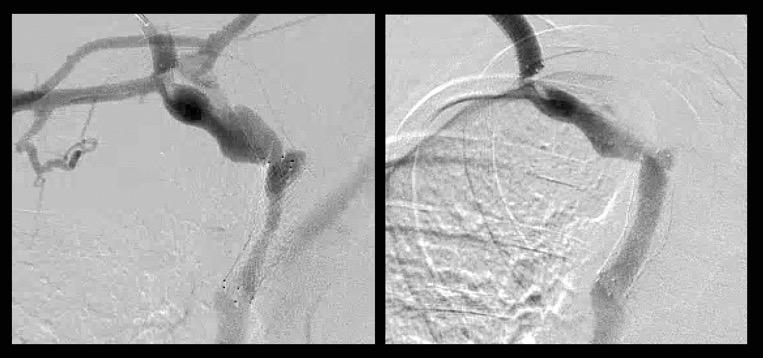 Endothelial proliferation in non-covered stent cephalic arch