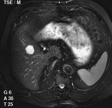Liver Hemngiom 113 c d Fig. 8.11 d. Hemngiom in ftty liver t MR imging.
