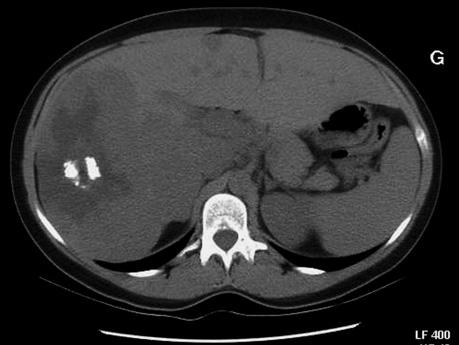 Liver Hemngiom 109 c Fig. 8.6-c. Gint cvernous hemngioms t CT.