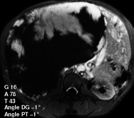 A smller hemngiom is seen in the IV liver segment.