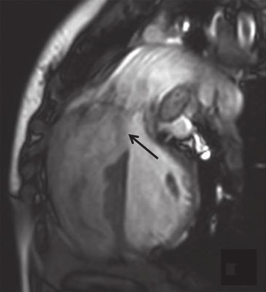 This antero-cephalad malalignment of the septum leads to the classic tetrad of subaortic ventricular septal defect (VSD), an overriding aorta, right ventricular (RV) infundibular stenosis and