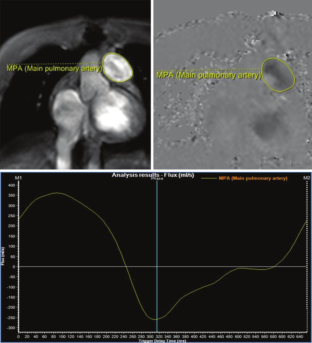 Chapter 46 Cardiac MRI in Post-TOF Repair dults 383 C Figure 46-3.