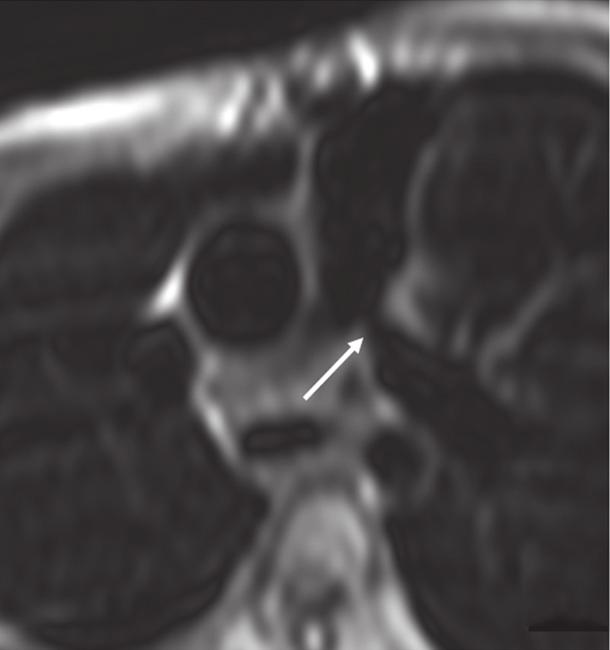 flow acceleration. Figure 46-6. SSFP axial images of two different post-icr patients showing RV dilatation and TR jet (arrow).
