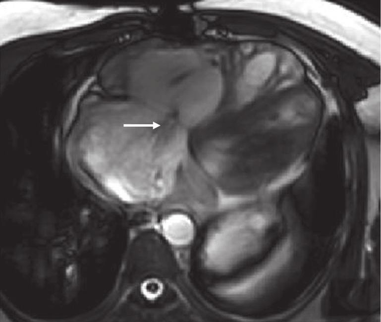 Extensive infundibular muscle resection and ischaemic insult may also be responsible in some cases 17. Presence of RV outflow tract aneurysm results in reduced RV ejection fraction 18.