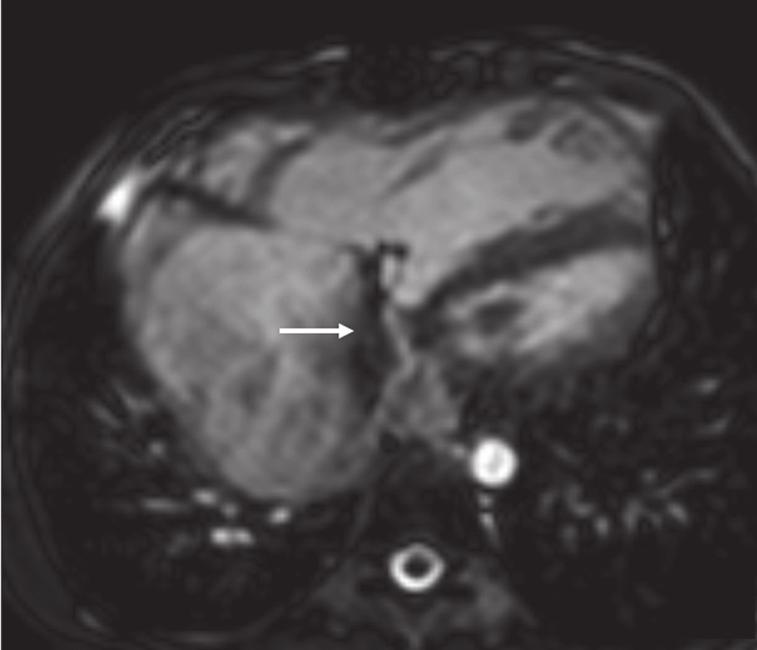 Conduit Obstruction Patients who require a conduit as a part of initial repair may develop obstruction over time. This can be seen on multiple imaging sequences.