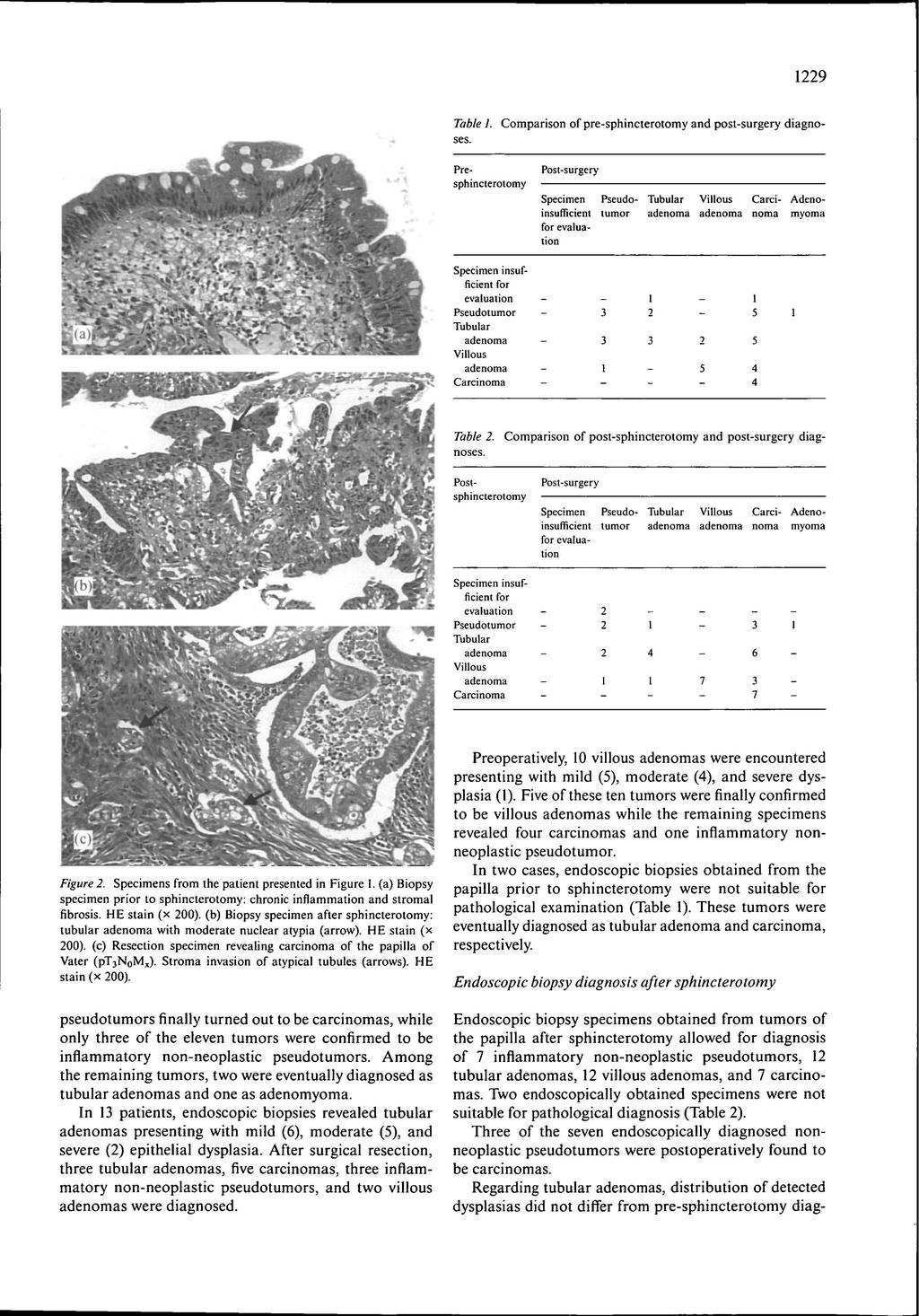 9 Table. Comparison of presphincterotomy and postsurgery diagnoses. Presphincterotomy Postsurgery Carci AdenoSpecimen Pseudo Tubular insufficient tumor noma myoma for I ft. ; Tubular Table.