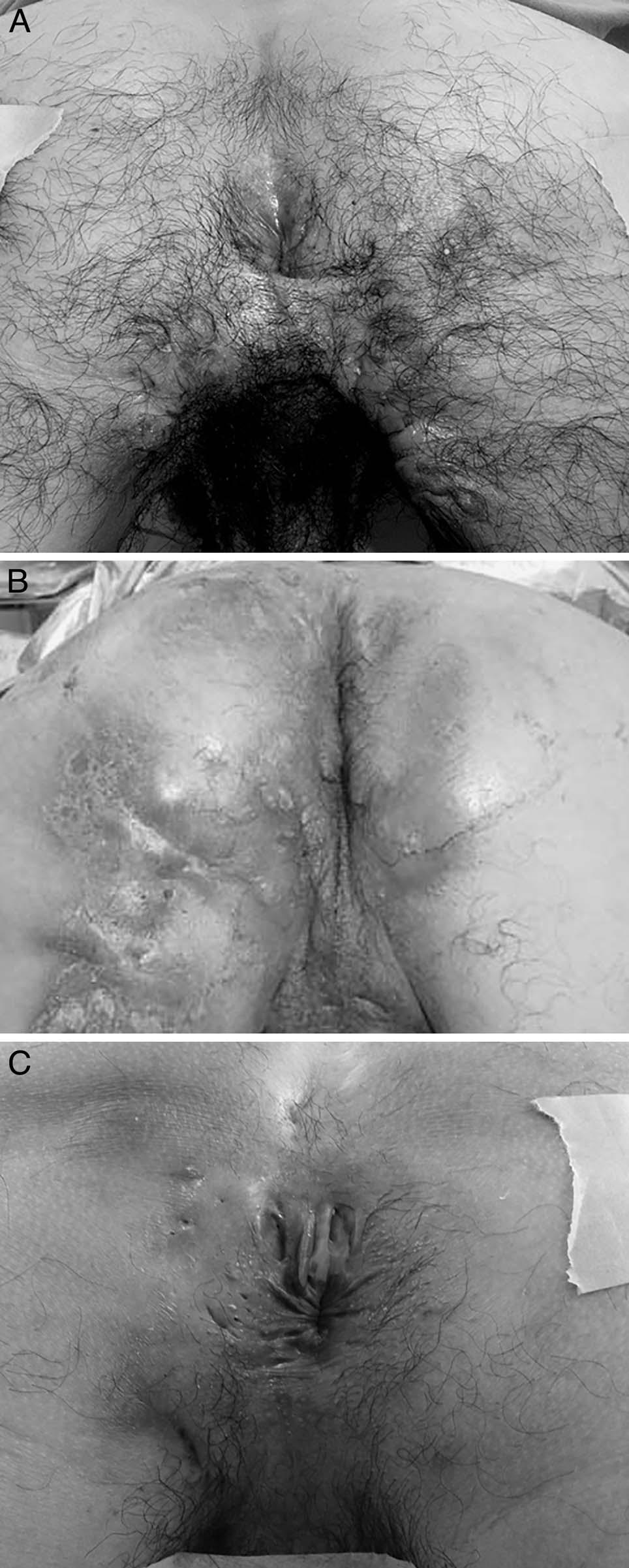 TOKUNAGA MODIFIED SETON FOR ANAL FISTULAS Table 1 Patients characteristics, preoperative findings, and results Case Age, y Anal fistula HS Hospital stay, d Seton duration, mo 1 32 Trans Bilateral
