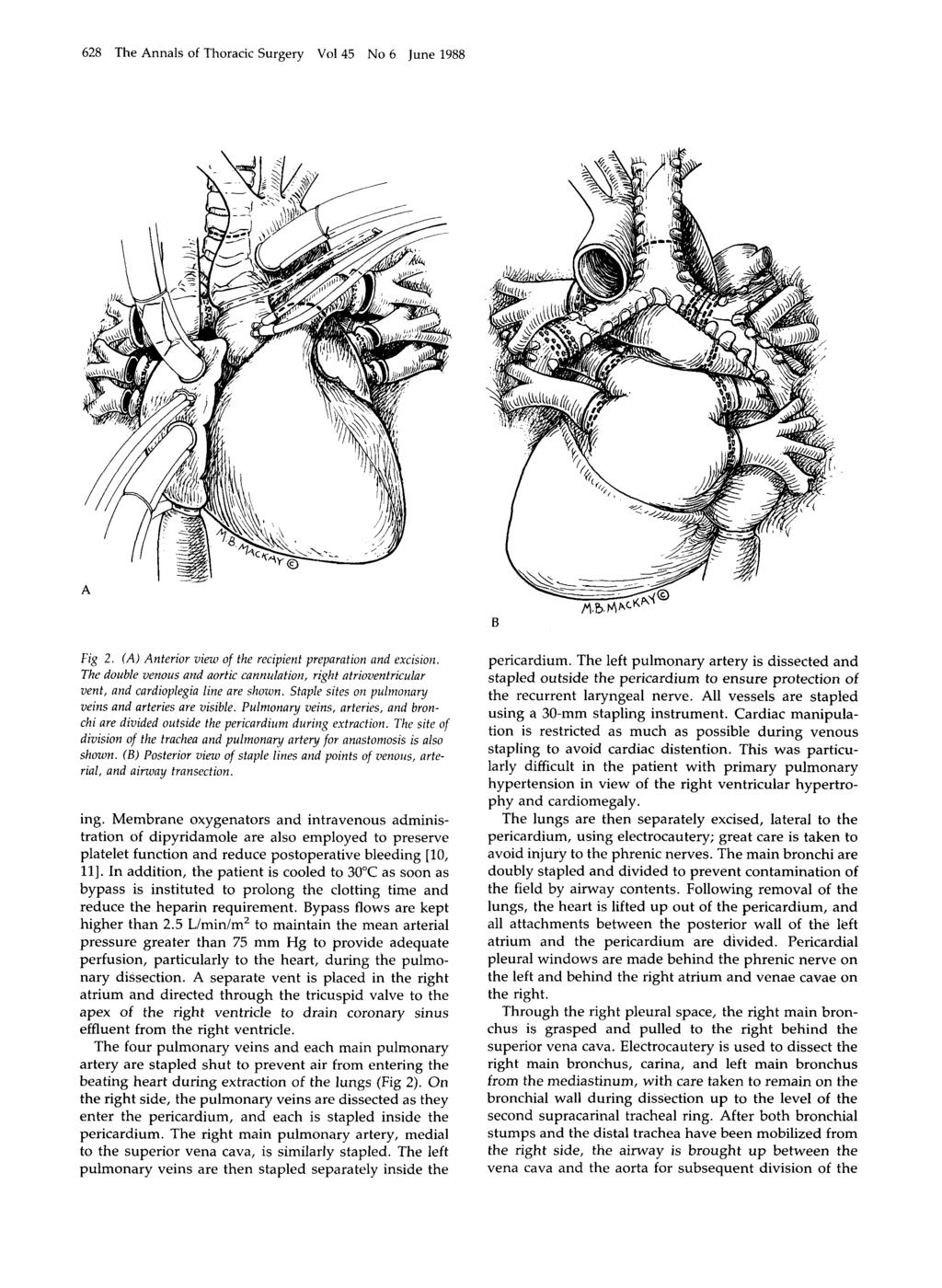 628 The Annals of Thoracic Surgery Vol 45 No 6 June 1988 Fig 2. (A) Anterior view of the recipient preparation and excision.