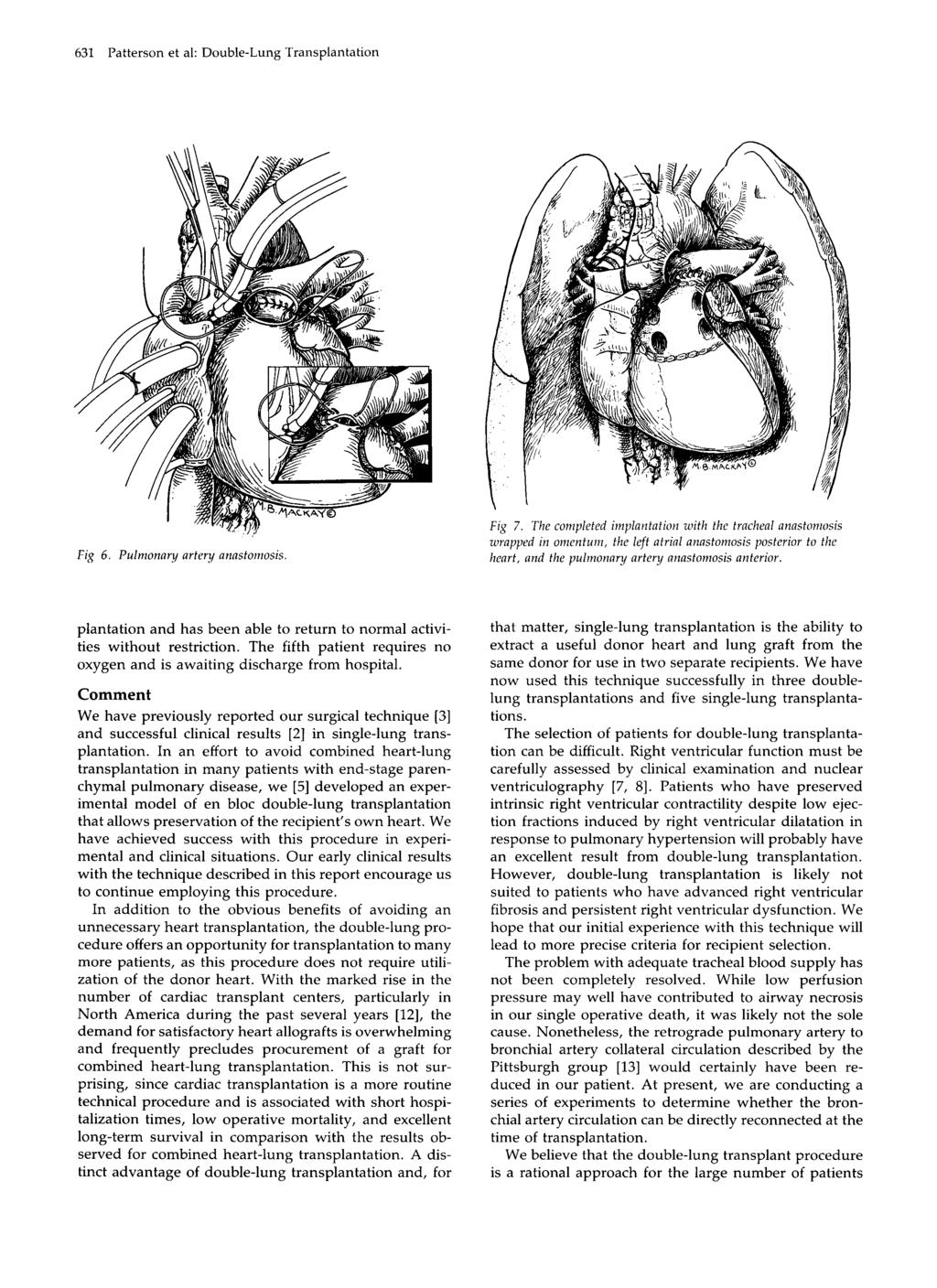 631 Patterson et al: Double-Lung Transplantation Fig 6. Pulmonary artery anastomosis Fig 7.