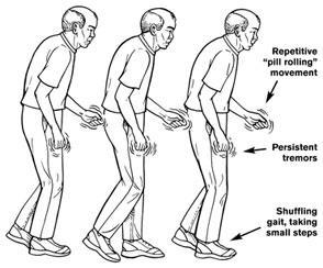 Diagnosis Neurologic exam: Limb stiffness? Animated expression? Tremor? Normal gait?