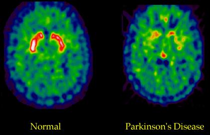 Diagnosis Neuroimaging: DaTscan MRI Transcranial Doppler ultrasonography PET SPECT