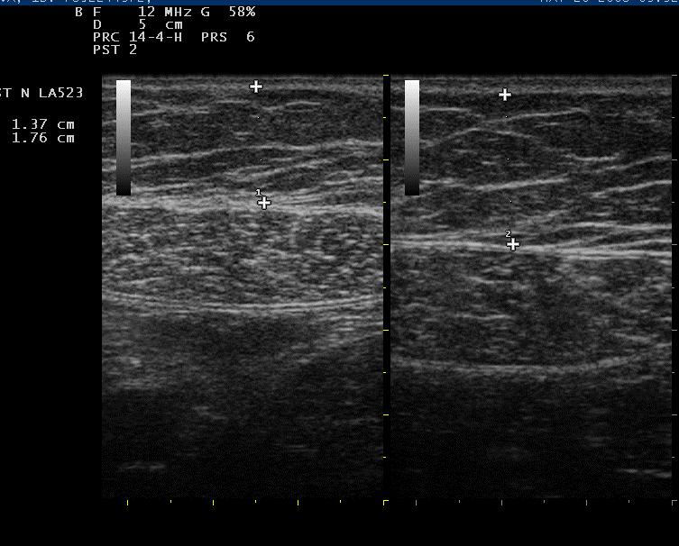 Left abdominal part: R (without compression) Left abdominal part: L (with compression) REFERENCES: 1.Caroline M. Pond, Postgraduate Medical Journal 76: 671, November 2000. 2.Miner J. L. The adipocyte as an endocrine cell.