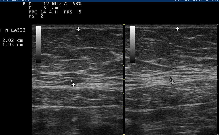 After the UltraContourÖ High Focalised Ultrasounds and UltraContourÖ UMD treatment, there was no lymphedema in subcutis, intraparenchymal hematoma or focal reactive abrasive skin objectively