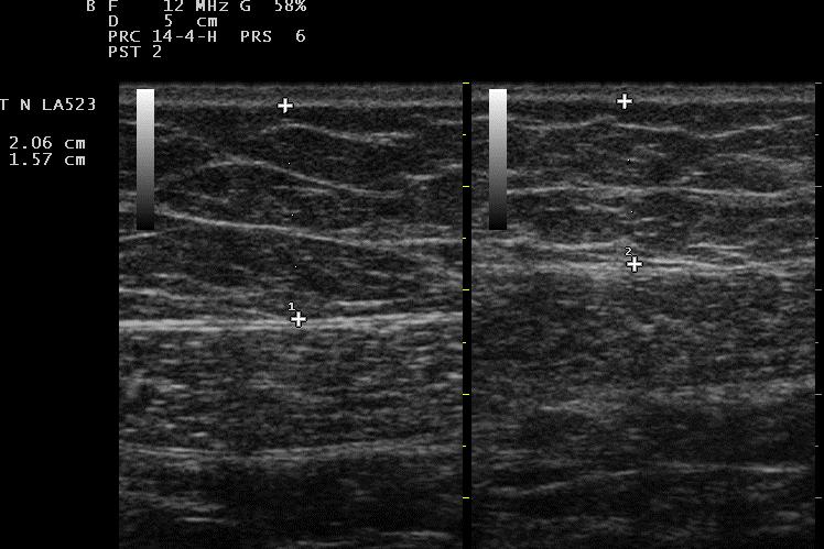 pressure, left part of the picture, the measurements performed in maximal compression, during the measurements in compression there are well visible comprimed fibrous septa above the muscle fascia
